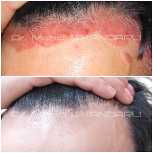 başda psoriaz
