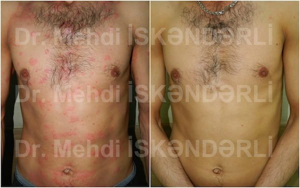 bədəndə qaşınma