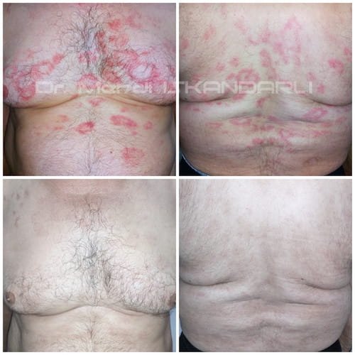 bədənə qaşıntılı qırmızı səpgilər