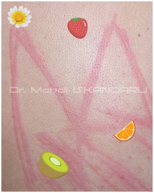 dermoqrafizm xəstəliyi