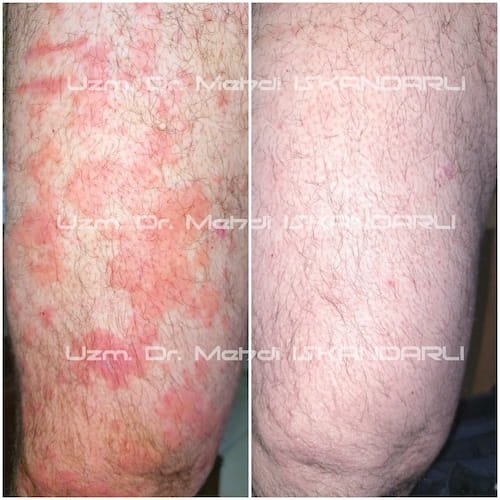 aşağı ətraflarda qaşınma