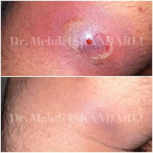 qasıqda ağrılı şişkinlik