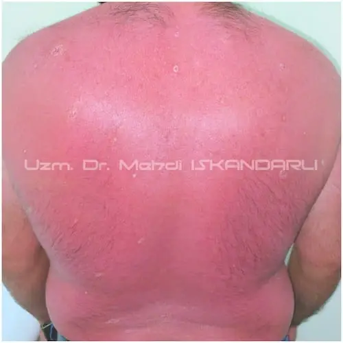 günəş yanığı