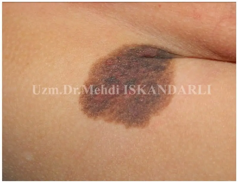 uşaqda qasıqda kongenital nevus