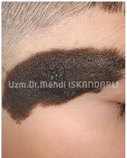 üzdə anadangəlmə qara ləkə