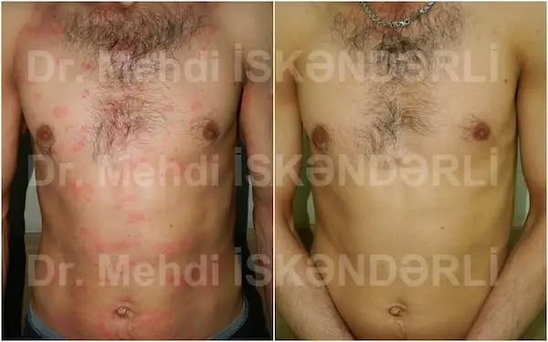 Bədəndə qaşınma verən qızartı