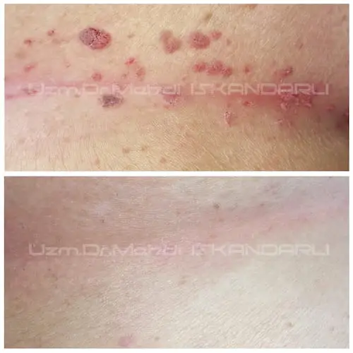 dəridə hpv papillomaları