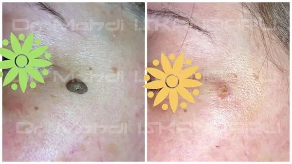 üzdə papilloma