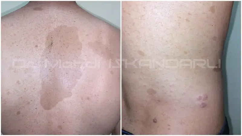 neyrofibromatoz xesteliyinin mualicesi