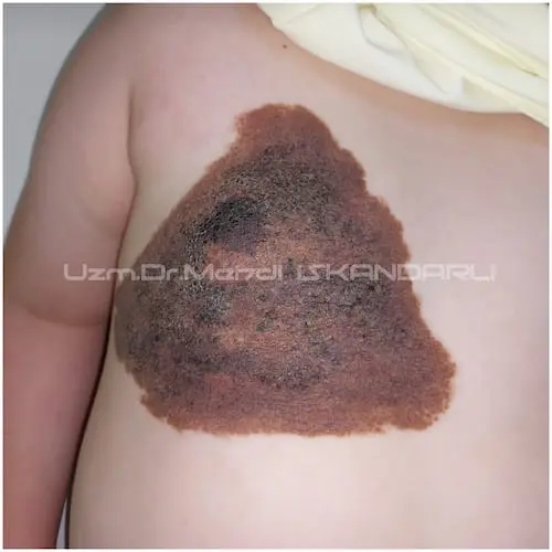 körpədə kongenital nevus