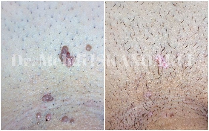 genital ziyilin müalicəsi