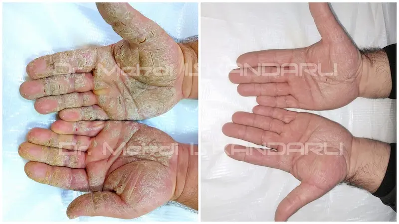 ovuclarda qabıqlanma